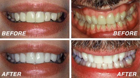 Teeth Bleaching Gel